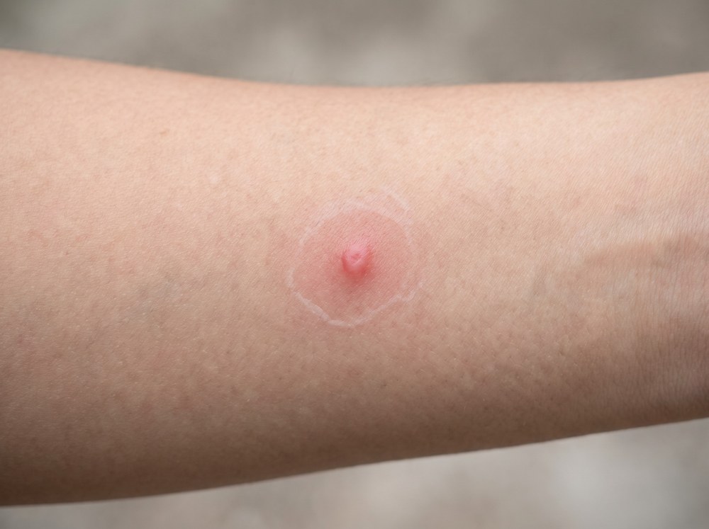 Close-up photo of a small red welt with a faint central puncture mark on skin from a rare accidental leaf-footed bug bite